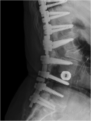 Analysis of instrumentation failures after three column osteotomies of ...