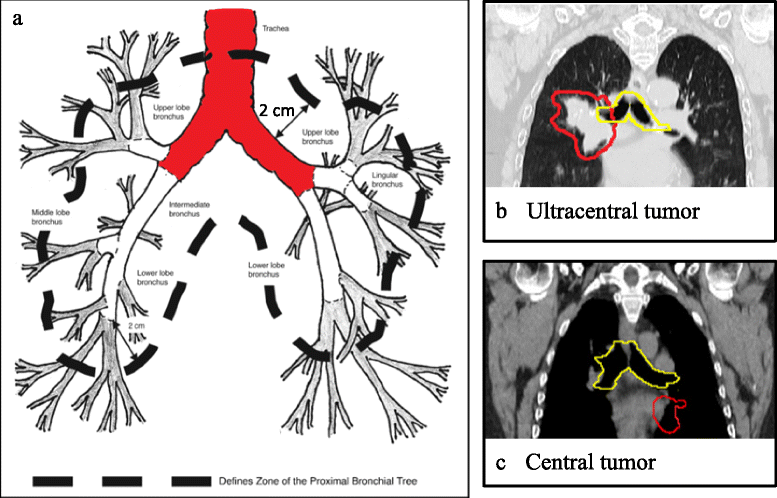 A critical review of recent developments in radiotherapy ... diagram of esophagus cancer 