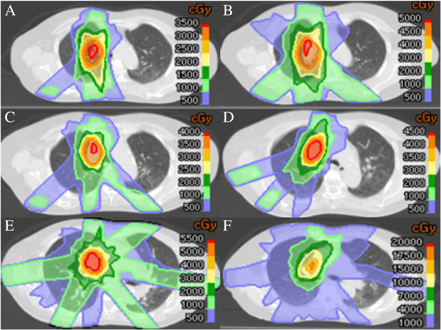 Repeat stereotactic body radiotherapy (SBRT) for local
