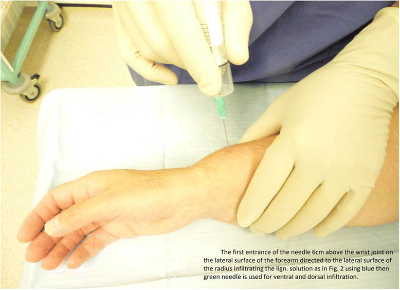 Periosteal nerve blocks for distal radius and ulna fracture