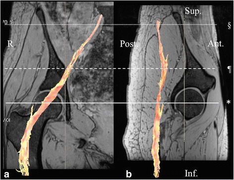 Diffusion tensor imaging and tractography of the sciatic and femoral