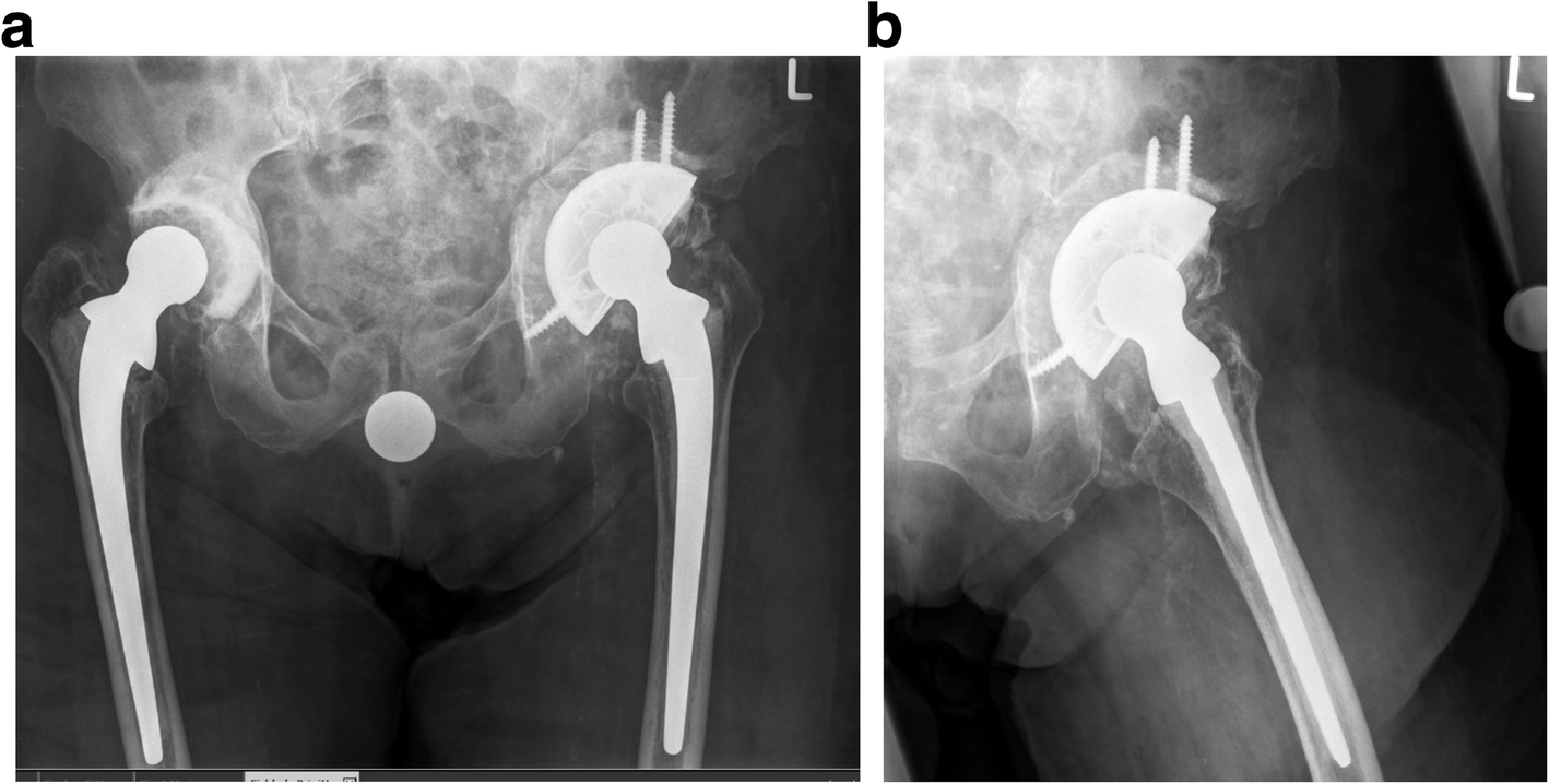 Reverse augmentation technique in hip revision arthroplasty a new