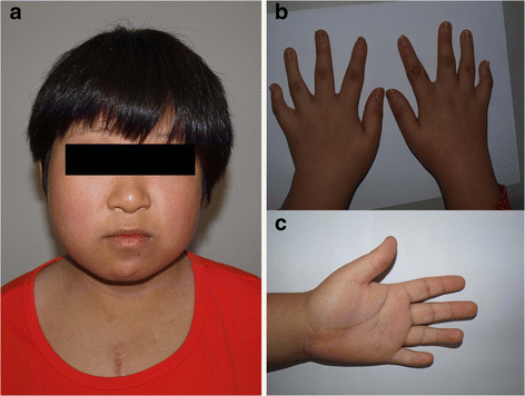 Flat Nasal Bridge And Epicanthal Folds - Trisomy 21 Docx Autism Down Syndrome : It is very ...