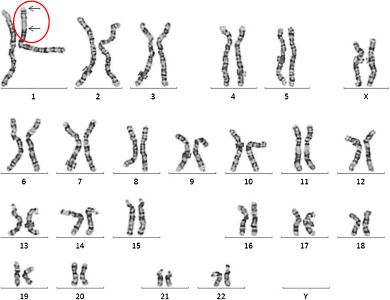 CANPMR syndrome and chromosome 1p32-p31 deletion syndrome coexist in ...