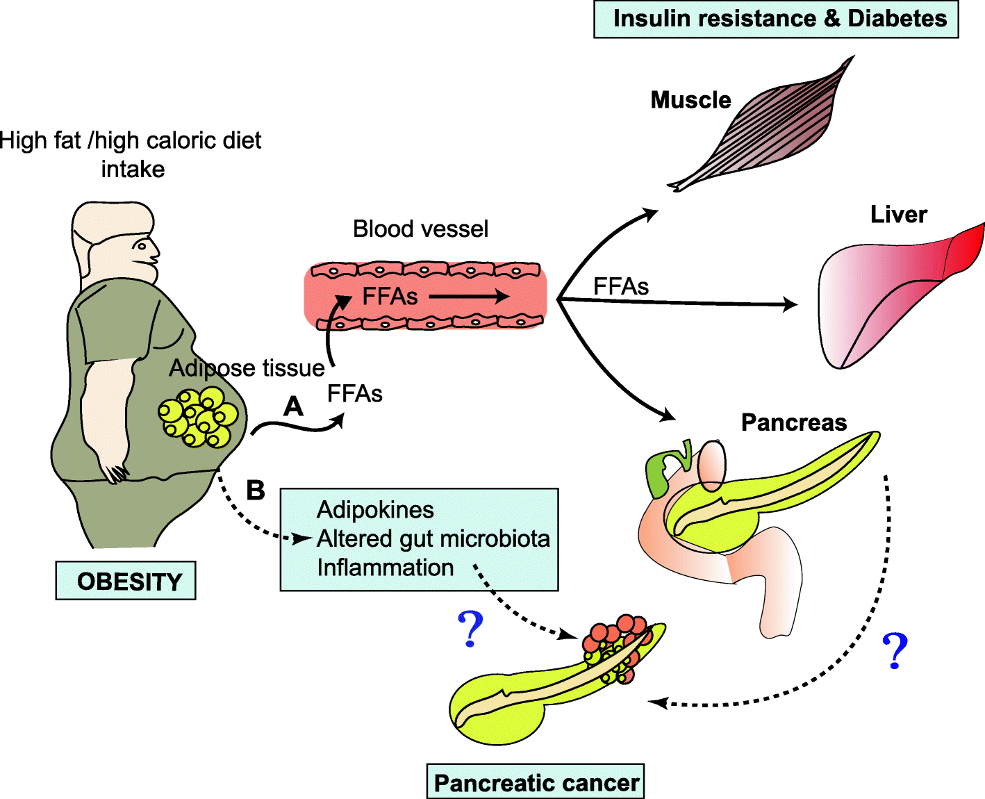 Pancreatic cancer associated with obesity and diabetes an