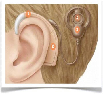 Pediatric cochlear implantation: an update | Italian ... microphone parts diagram 