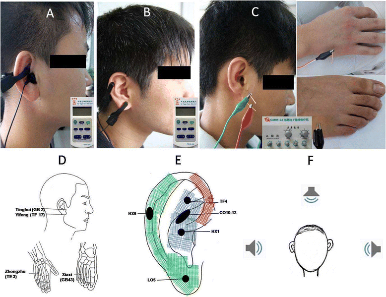 Transcutaneous Electrical Stimulation At Auricular Acupoints Innervated ...