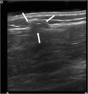 The importance of dynamic ultrasound in the diagnosis of tibialis ...