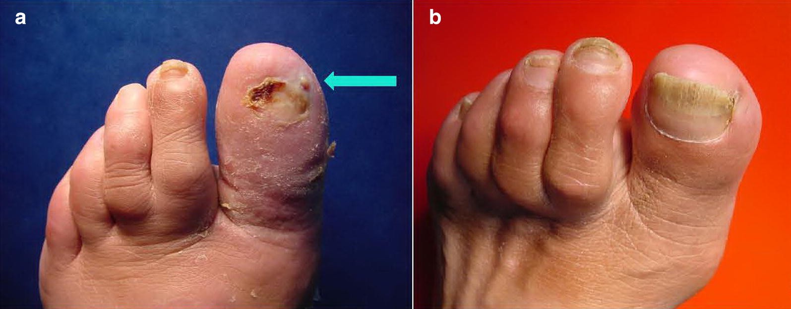 Ivermectin prophylaxis
