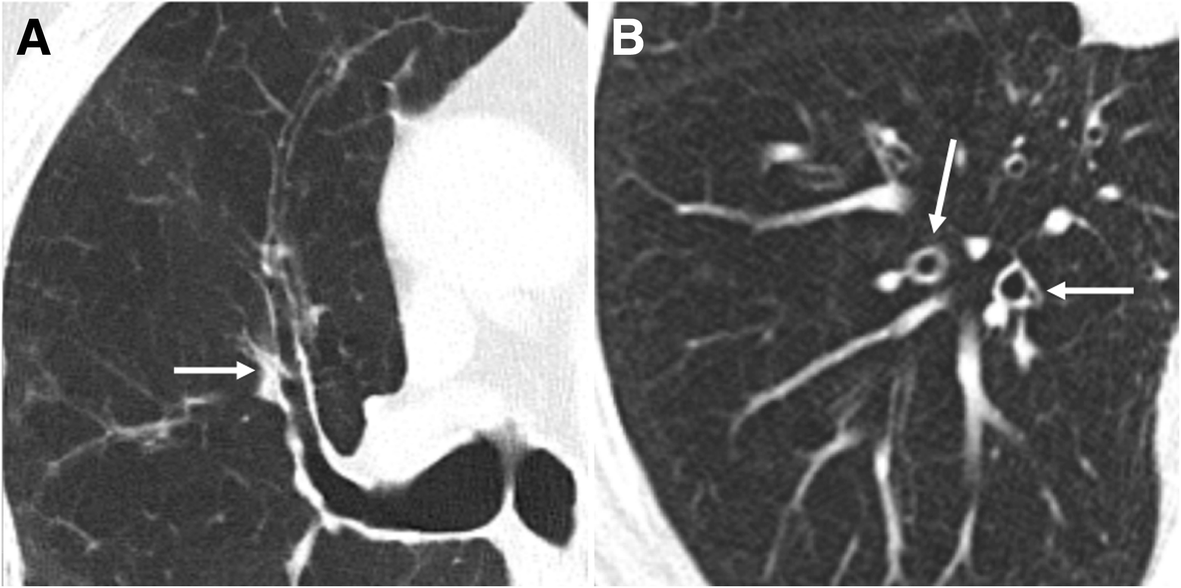 Diffuse smokingrelated lung diseases insights from a radiologic