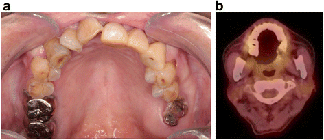 mucosal radiotherapy melanoma oral carbon