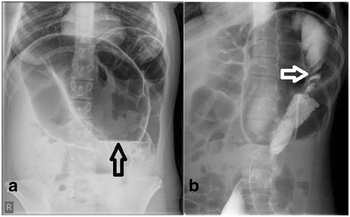 Sigmoid volvulus in children: a case report | Journal of ...
 Volvulus X Ray Omega Sign