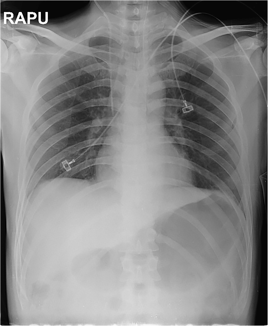 distended stomach in diabetic coma x ray