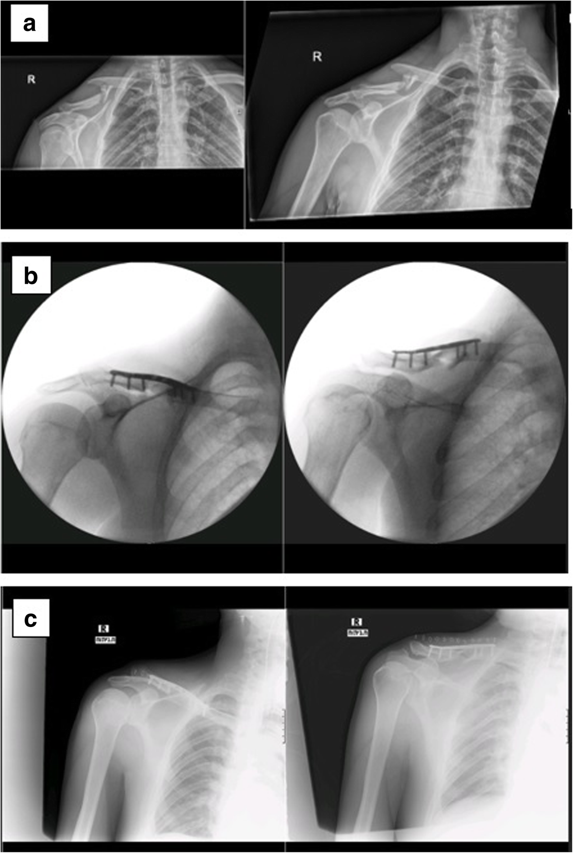 Mechanical failure of plate breakage after open reduction and plate