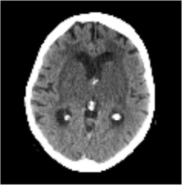 Coma And Cerebral Imaging | SpringerPlus | Full Text