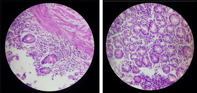 Subacute Intestinal Obstruction By Enterolith A Case Study 