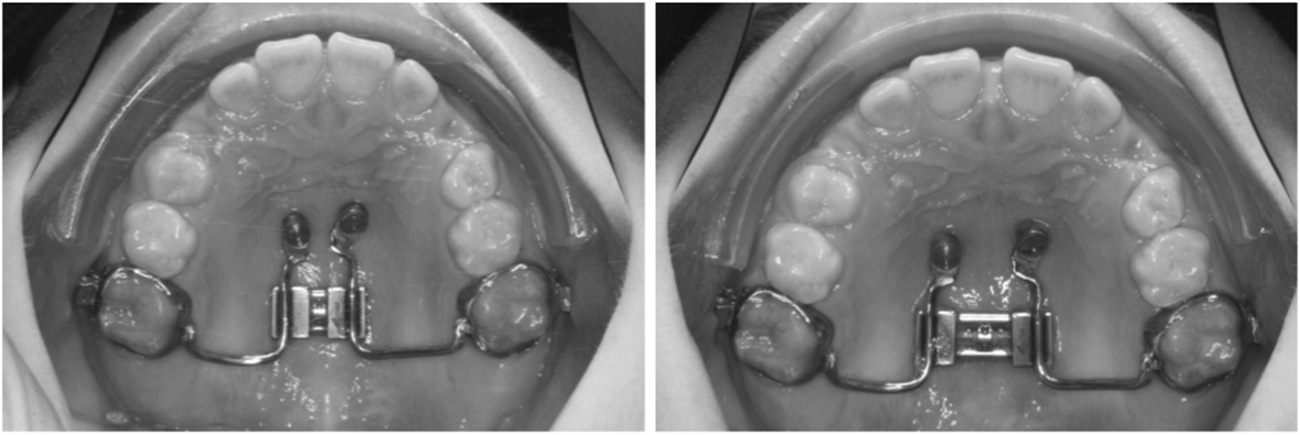 after oral weeks 8 test Class in Facemask III Hybrid with treatment Early Hyrax after oral weeks 8 test Class in Facemask III Hybrid with treatment Early Hyrax