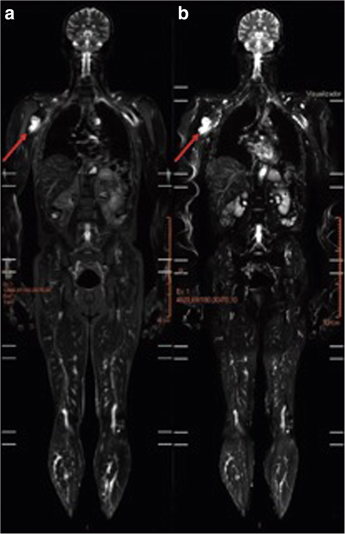 Wholebody resonance imaging of LiFraumeni
