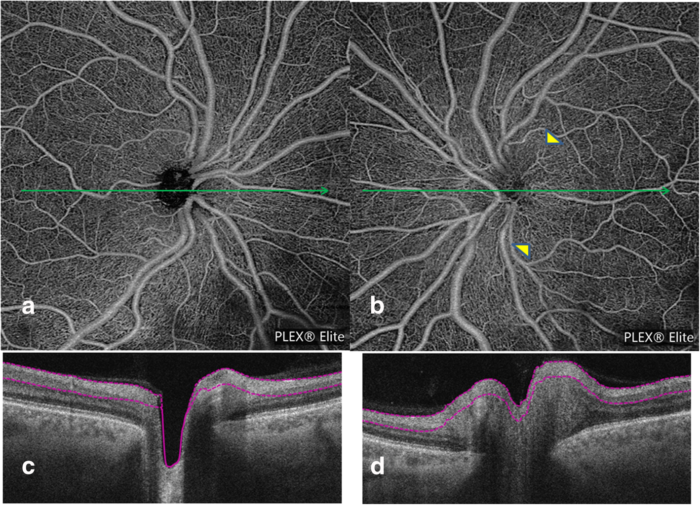 Optical coherence tomography angiography at the acute phase of optic