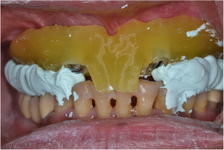 Using the surgical guide for impressionfree digital bite registration in the edentulous maxilla