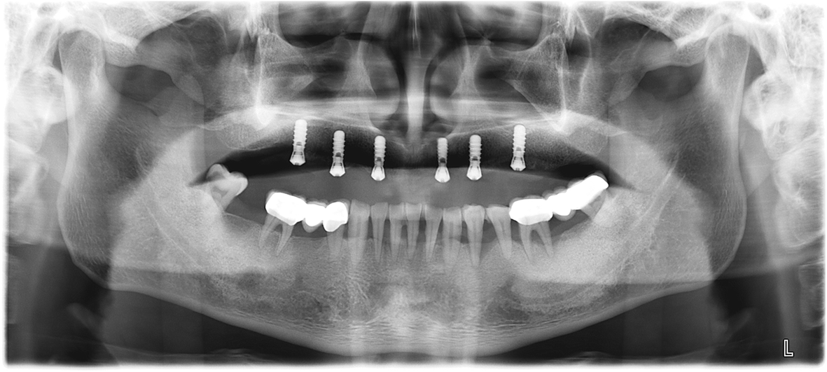 Using the surgical guide for impressionfree digital bite registration in the edentulous maxilla