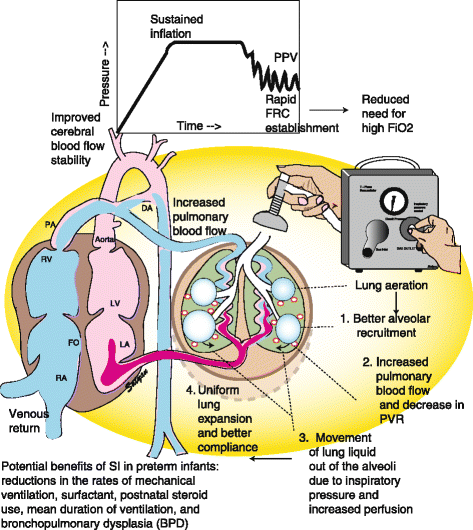 Neonatal Resuscitation: Evolving Strategies | Maternal Health ...