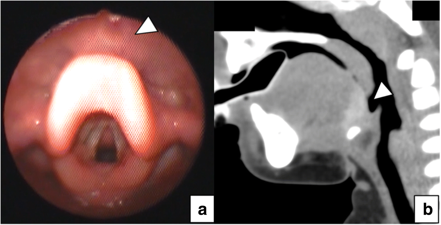 Laryngo fiberscopyguided suspension procedure for an ectopic lingual thyroid obstructing airway