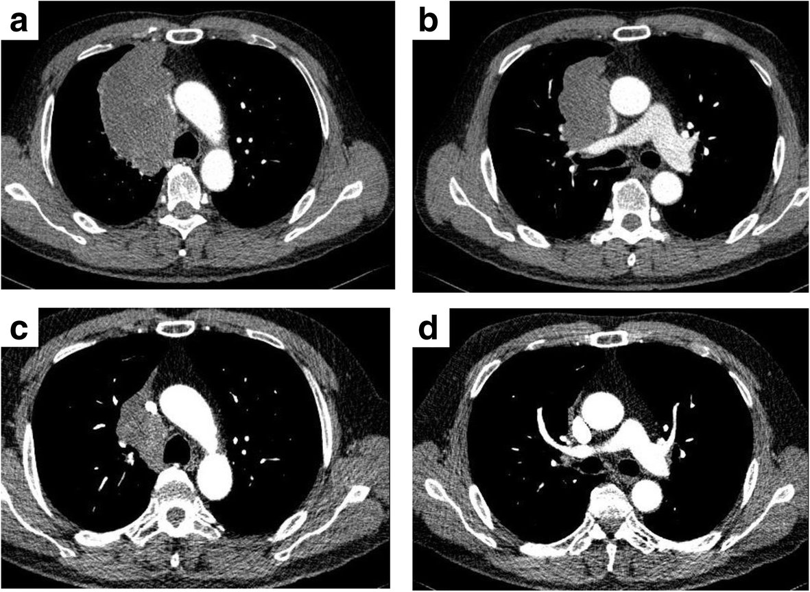 A case of primary pulmonary leiomyosarcoma completely resected after ...