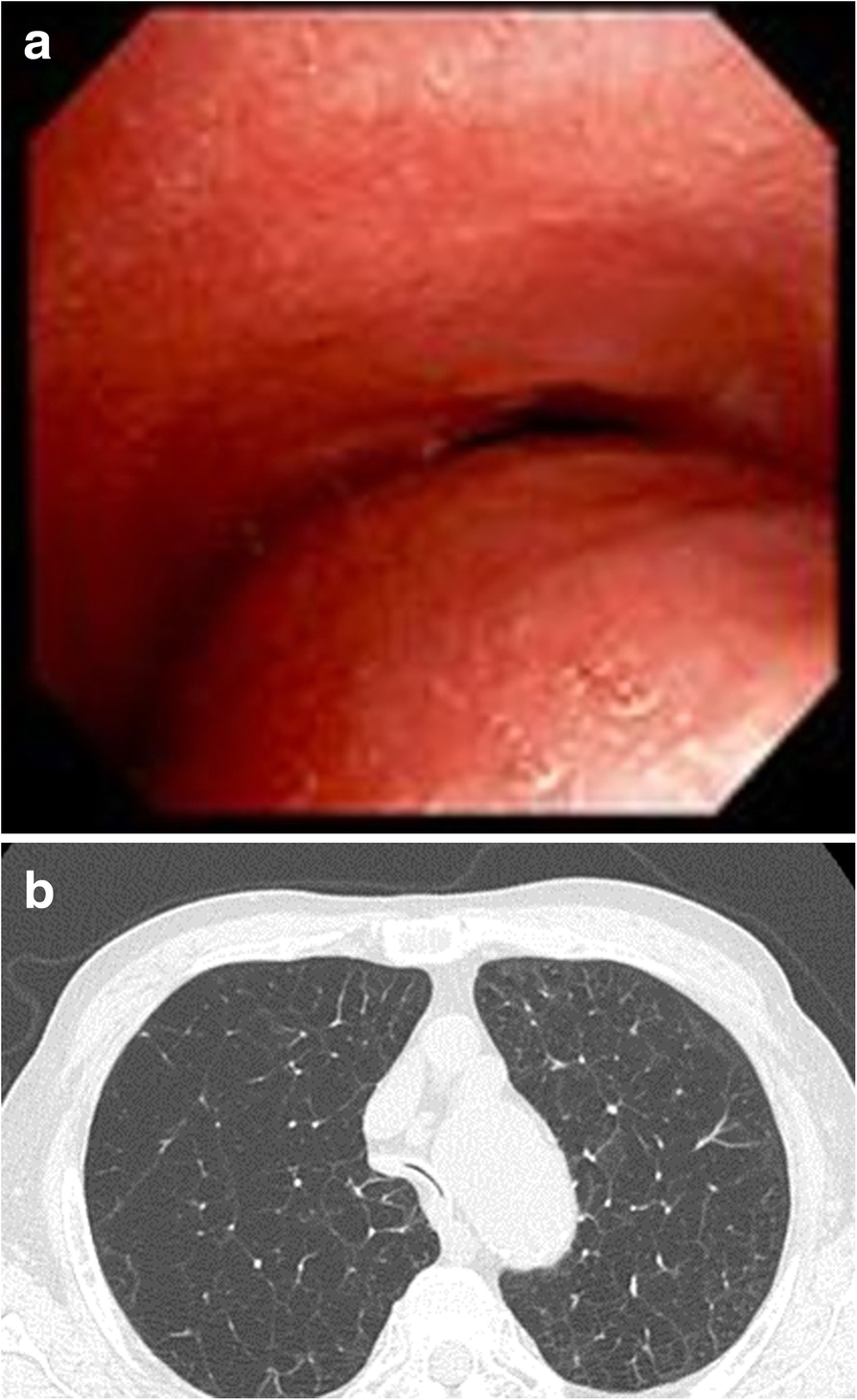 Thoracoscopic plication of the membranous portion of crescenttype