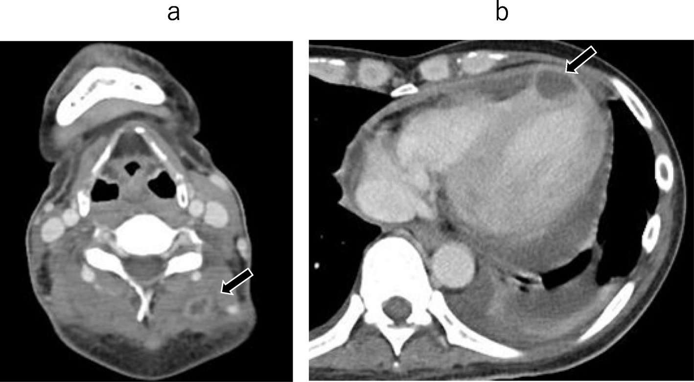 Successful treatment of Aspergillus mural endocarditis in malignant