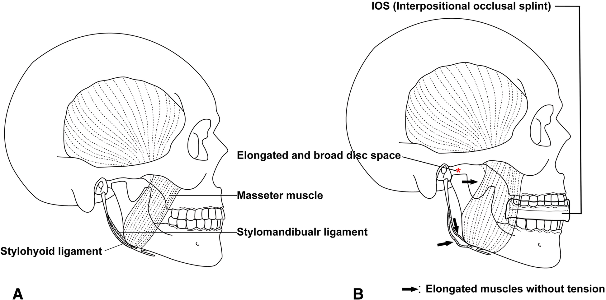 Gap arthroplasty with active mouth opening exercises using an interocclusal splint in