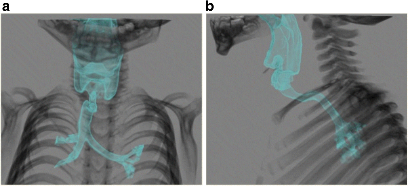 Anesthetic management of a child with KagamiOgata syndrome complicated