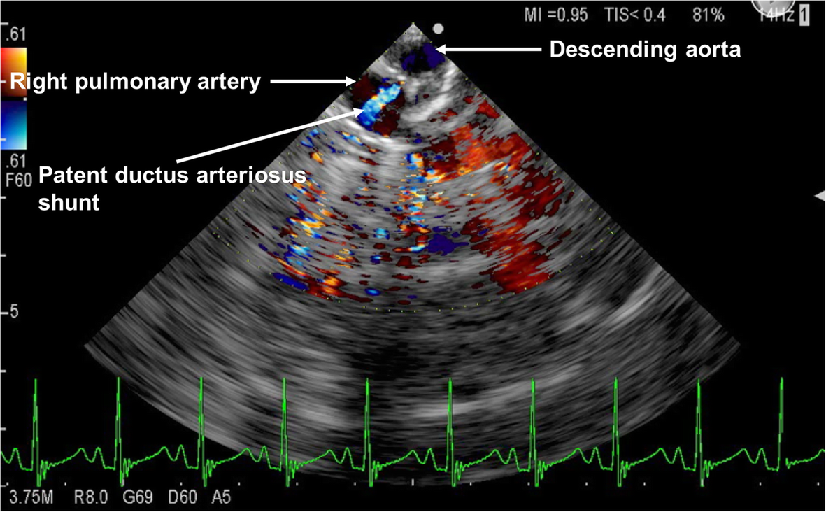 Residual shunt in an infant following patent ductus arteriosus ligation