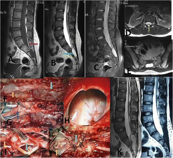 Classification, mechanism and surgical treatments for spinal canal