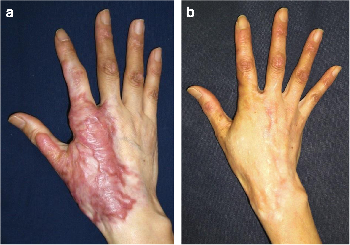 Surgery For Scar Revision And Reduction: From Primary Closure To Flap ...