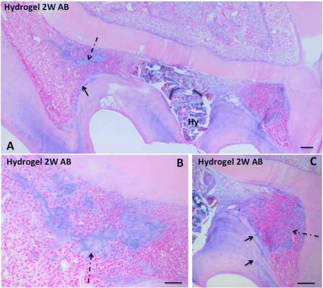 Reactionary and reparative dentin formation after pulp capping