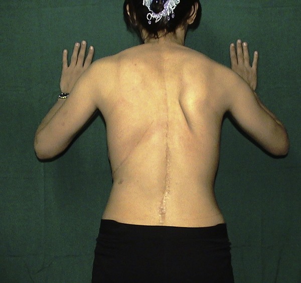 Isolated long thoracic nerve paralysis - a rare complication of