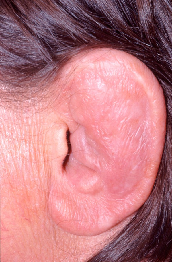 Relapsing polychondritis associated with bilateral stapes footplate