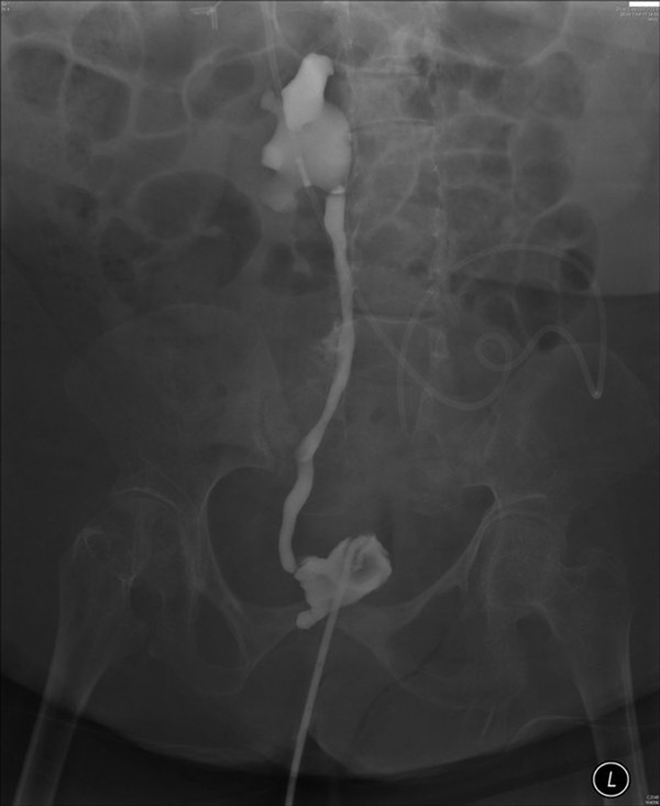 Use of openended Foley catheter to treat profuse urine leakage around