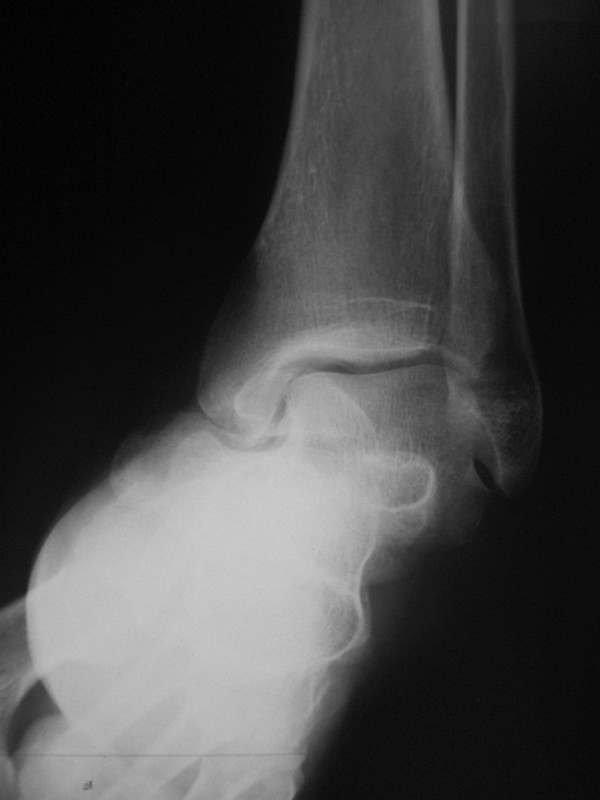 nondisplaced fracture nondisplaced fracture