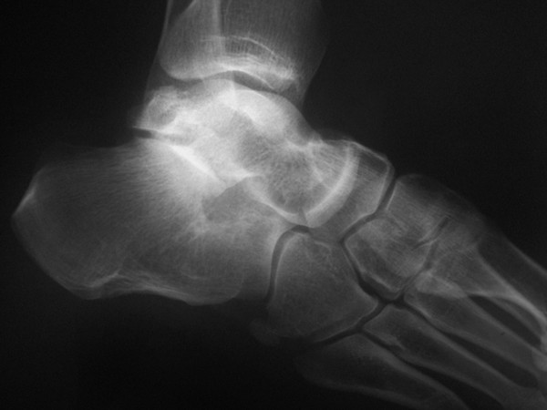 Closed subtalar dislocation with non-displaced fractures ...