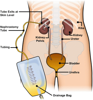 Ureteral Stents, Nephrostomy Tubes, and Urethral Dilators | SpringerLink
