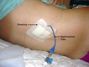 Ureteral Stents, Nephrostomy Tubes, and Urethral Dilators | SpringerLink