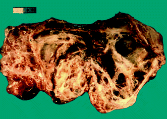 Tumors With Functioning Stroma Springerlink