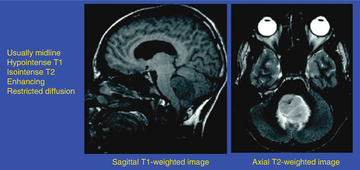 Primitive Neuroectodermal Tumor, Fig. 1