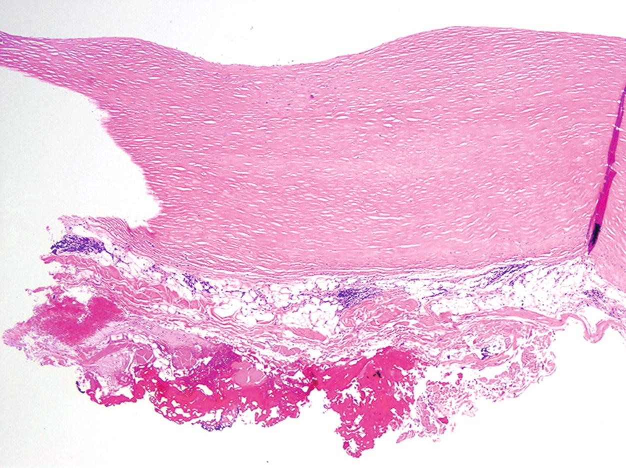 Pleural Plaques, Fig. 2