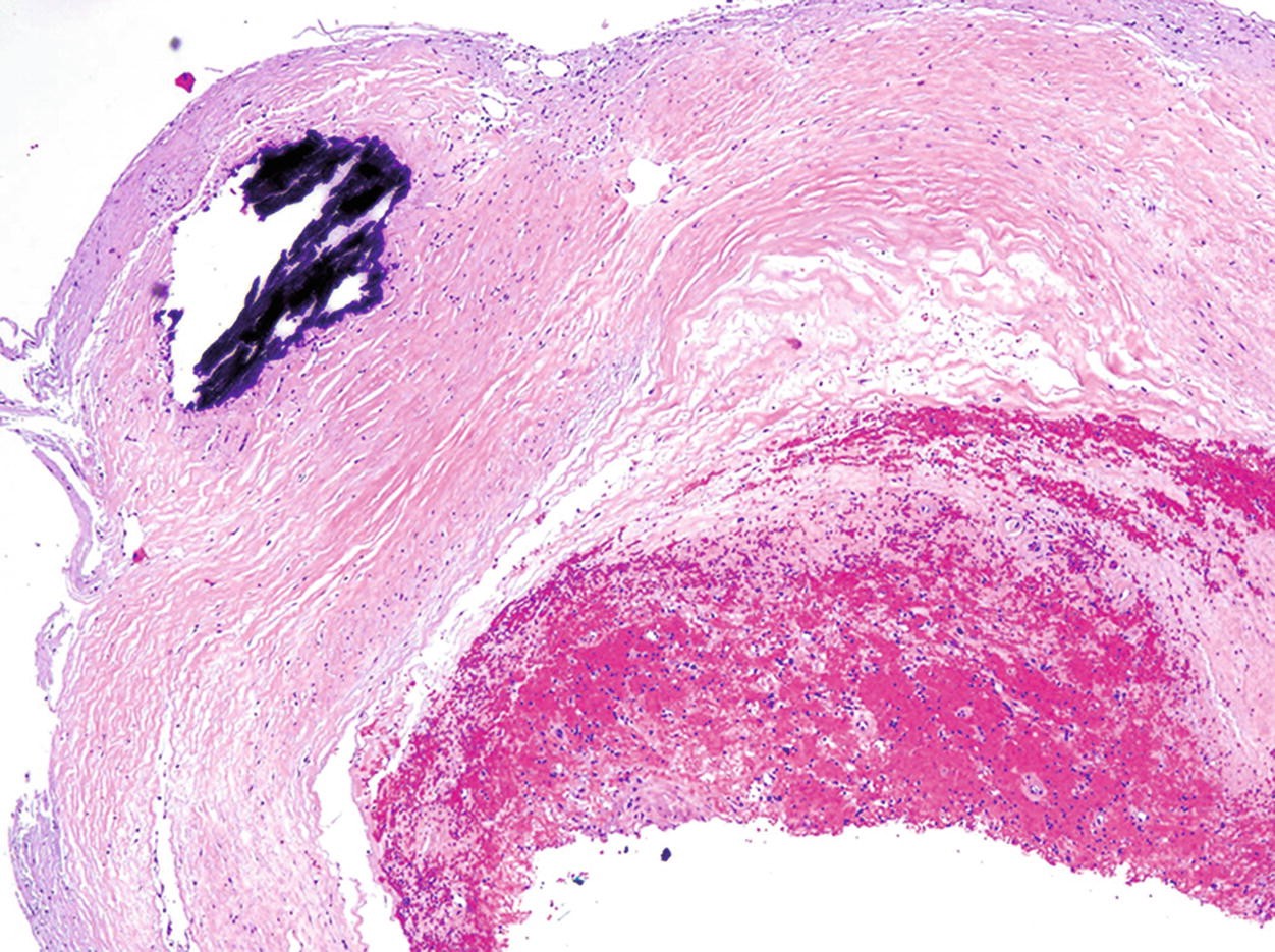 Pleural Plaques, Fig. 4