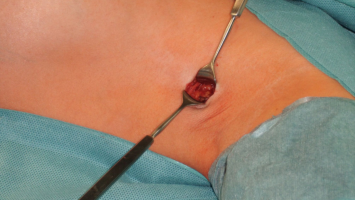 Sentinel-Node-Biospie