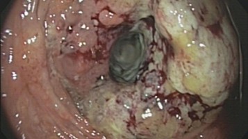 Kolorektales Karzinom