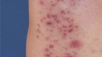 Acne inversa